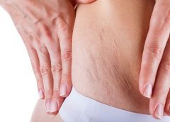 Tips and tricks – Get rid of the stretch marks naturally; Check details