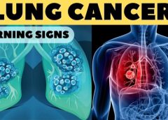Don’t ignore these signs it can be Warning signs of Lung Cancer